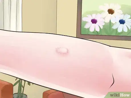 Imagen titulada Heal from a Skin Biopsy Step 12