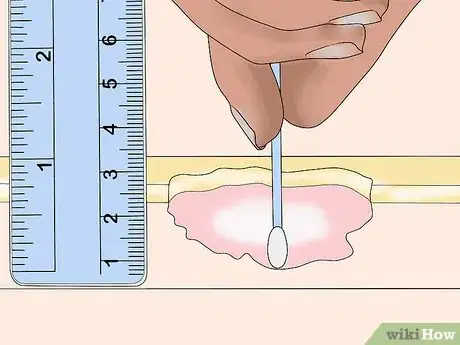 Imagen titulada Measure Wounds Step 5