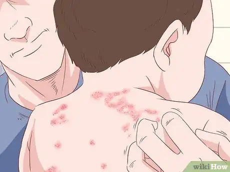 Imagen titulada Treat Hand Eczema Step 4