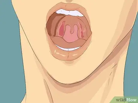 Imagen titulada Fake Strep Throat Step 1