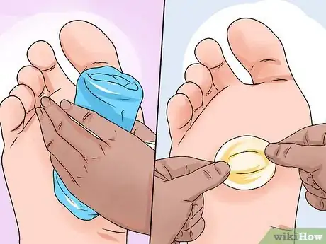 Imagen titulada Care for a Burst Blister Step 8