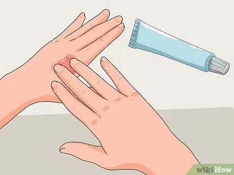Imagen titulada Treat a Hand Burn Step 7