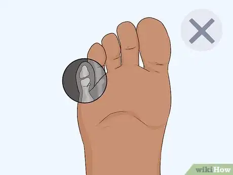 Imagen titulada Buddy Tape an Injured Toe Step 6