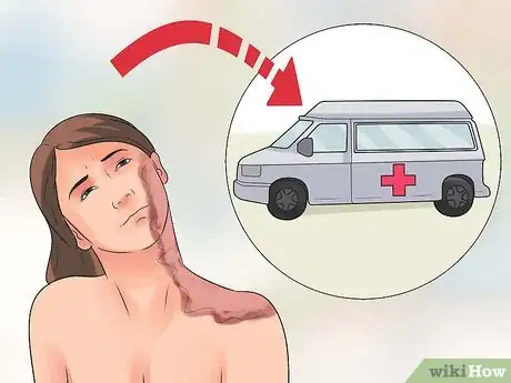 Imagen titulada Treat a Hot Water Spill on Your Skin Step 6