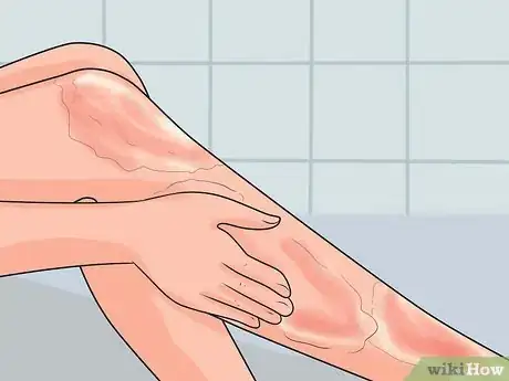 Imagen titulada Treat a Hot Water Spill on Your Skin Step 5