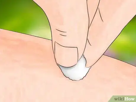 Imagen titulada Get Bug Bites to Stop Itching Step 16
