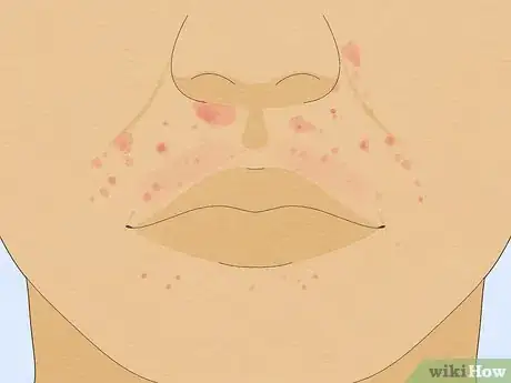 Imagen titulada Treat a Face Rash After Waxing Step 1