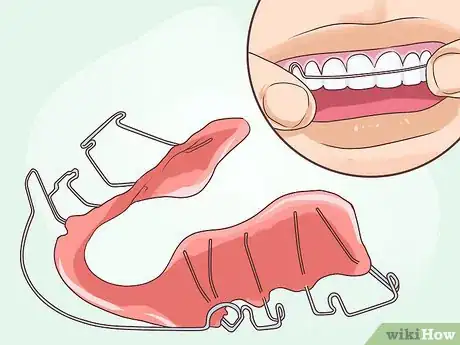 Imagen titulada Put on a Retainer Step 1