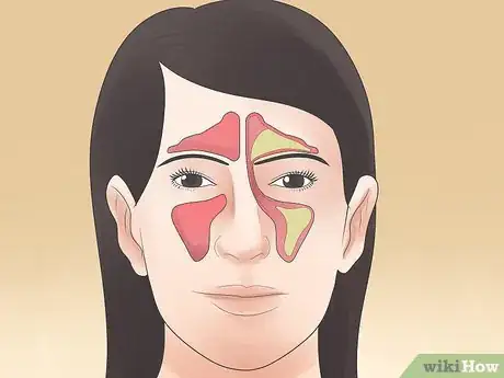 Imagen titulada Stop Sinus Headaches Step 10