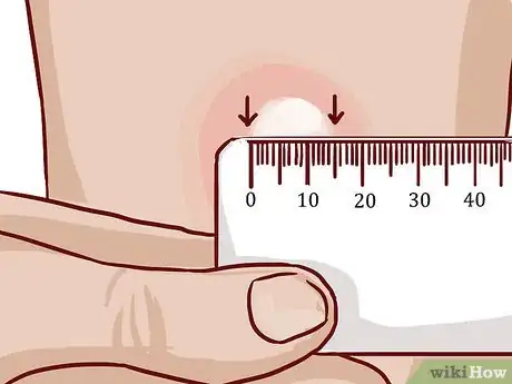 Imagen titulada Read a Tuberculosis Skin Test Step 7