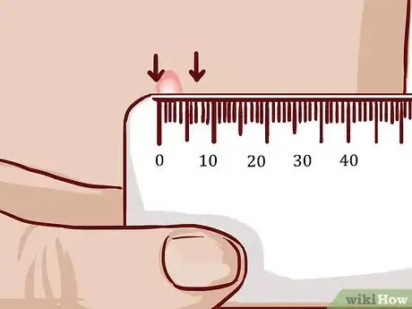Imagen titulada Read a Tuberculosis Skin Test Step 9