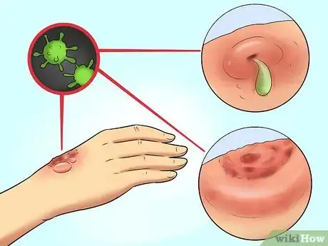 Imagen titulada Treat Minor Burns Step 11