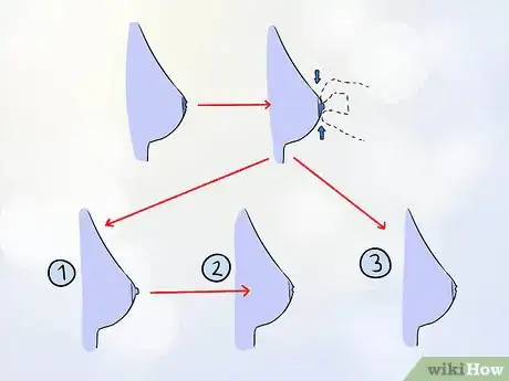 Imagen titulada Get Rid of Inverted Nipples Step 1