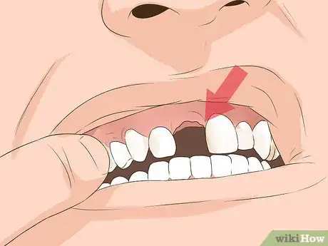 Imagen titulada Heal a Bitten Tongue Step 4