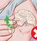 quitar un tatuaje