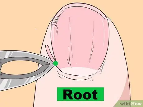 Imagen titulada Get Rid of Psoriasis on Your Nails Step 11