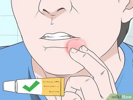 Imagen titulada Cover Up a Cold Sore Step 3