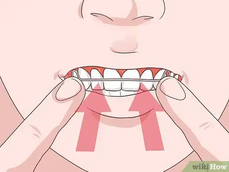Imagen titulada Put on a Retainer Step 4