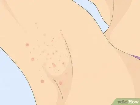Imagen titulada Treat a Face Rash After Waxing Step 9