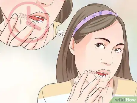 Imagen titulada Tell if You Have a Cold Sore Step 6