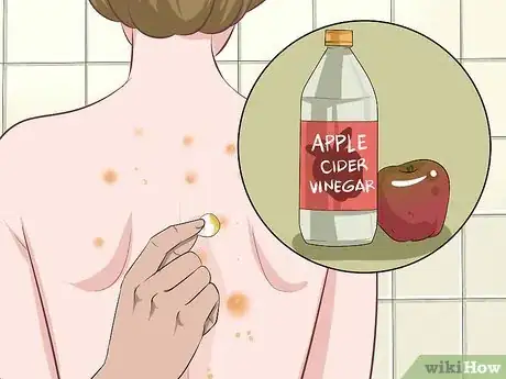 Imagen titulada Get Rid of Back Acne Fast Step 8