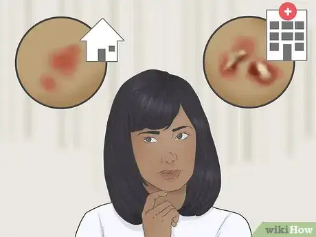 Imagen titulada Treat Wax Burns Step 3