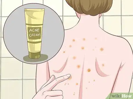 Imagen titulada Get Rid of Back Acne Fast Step 3