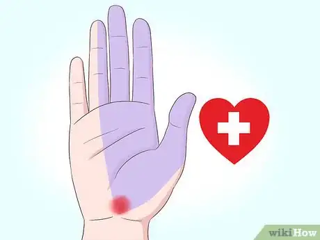 Imagen titulada Reduce Swollen Fingers Step 5