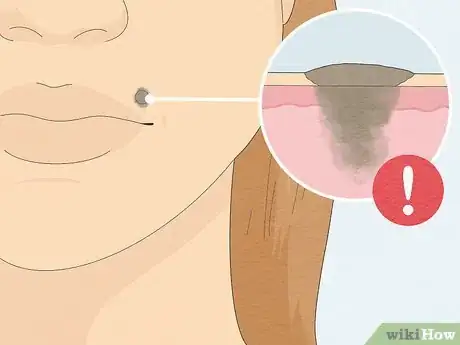 Imagen titulada Remove a Mole with Iodine Step 2