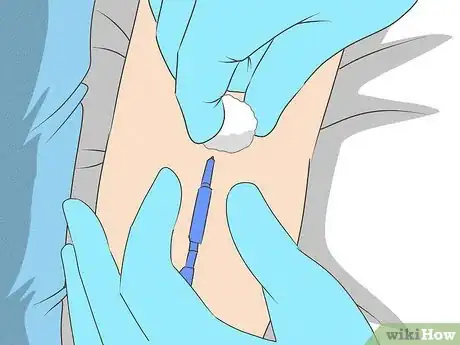 Imagen titulada Remove a PICC Line Step 6