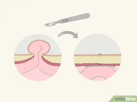 Imagen titulada Treat a Hernia at Home Step 15