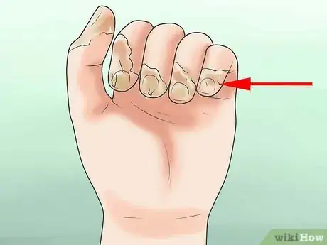 Imagen titulada Prevent Frostbite Step 37