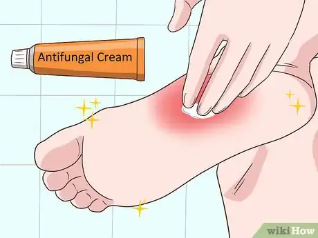 Imagen titulada Treat Tinea Step 3