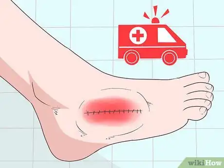 Imagen titulada Reduce Swelling After Surgery Step 4