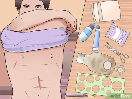 Imagen titulada Change a Colostomy Bag Step 12