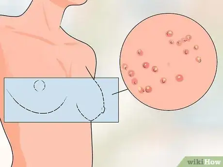 Imagen titulada Treat Itchy Breasts Step 11