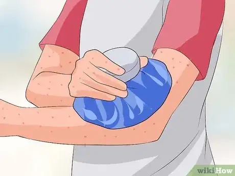 Imagen titulada Recognize Chickenpox Step 12