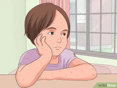 Imagen titulada Recognize Chickenpox Step 15
