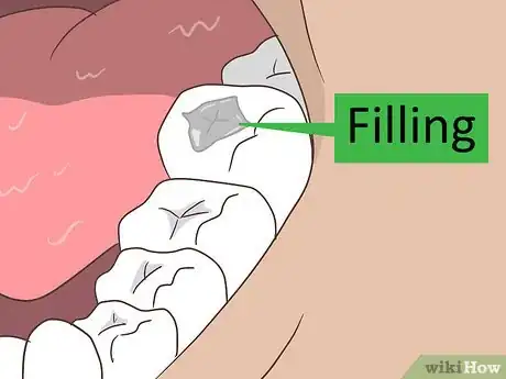 Imagen titulada Treat Cavities Step 4