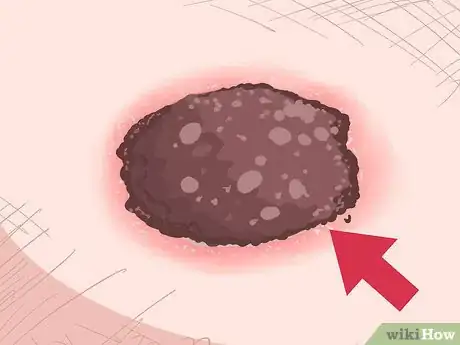 Imagen titulada Recognize Melanoma Step 2