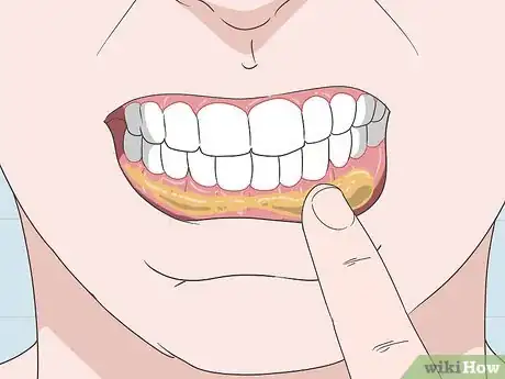 Imagen titulada Treat a Gum Infection Step 4