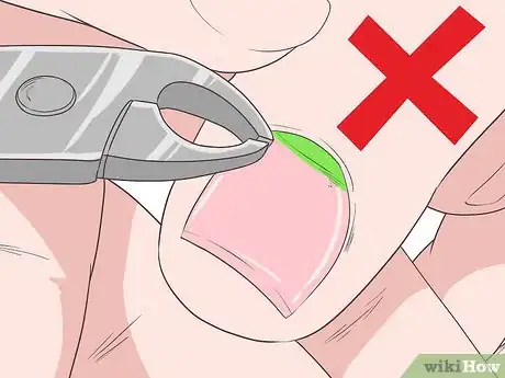Imagen titulada Get Rid of Psoriasis on Your Nails Step 14
