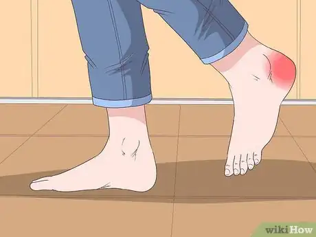 Imagen titulada Treat a Heel Bruise Step 1