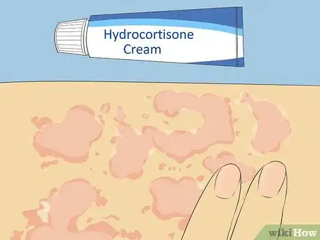 Imagen titulada Get Rid of a Rash Step 11