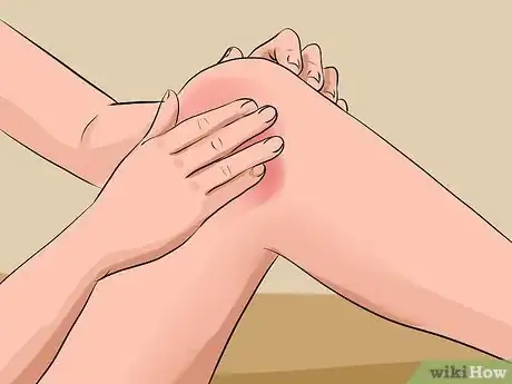 Imagen titulada Treat a Swollen Knee Step 9