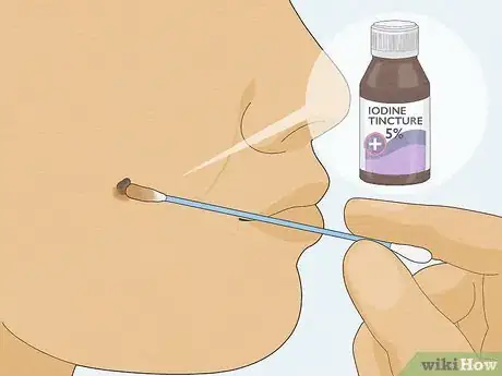 Imagen titulada Remove a Mole with Iodine Step 7
