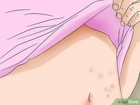 Imagen titulada Identify Bed Bug Bites Step 2