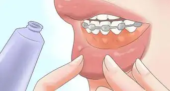 lidiar con un expansor de paladar