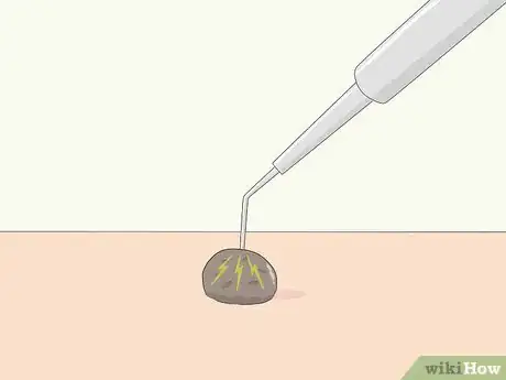 Imagen titulada Remove Moles Quickly Step 7