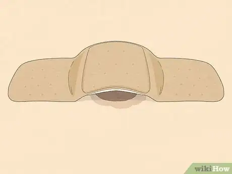 Imagen titulada Remove a Mole with Iodine Step 8